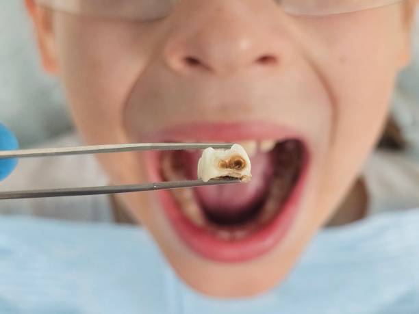 Best Dentist for Tooth Abscess  in Johnson, AR